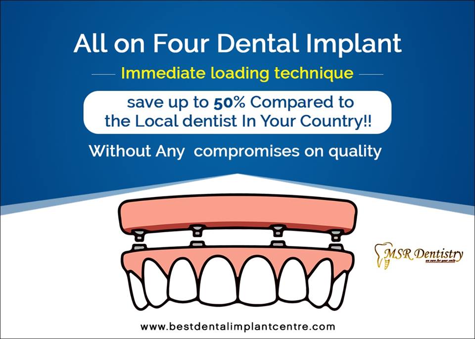 All On Four Dental Implants in Chennai