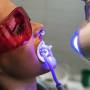 laser teeth whitening in chennai