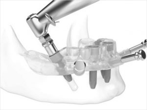 guided dental implants in Chennai