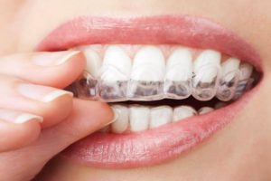 invisible braces cost in chennai