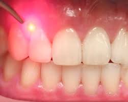 Soft-tissue-Laser-Dentistry-in-Chennai