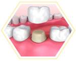dental crowns and tooth bridges in chennai
