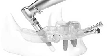 Dental Implant Treatments